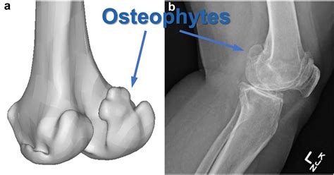 What is the Effect of Posterior Osteophytes on Flexion and Extension Gaps in Total Knee ...