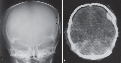 Injuries of Extracranial, Cranial, Intracranial, Spinal Cord, and Peripheral Nervous System ...