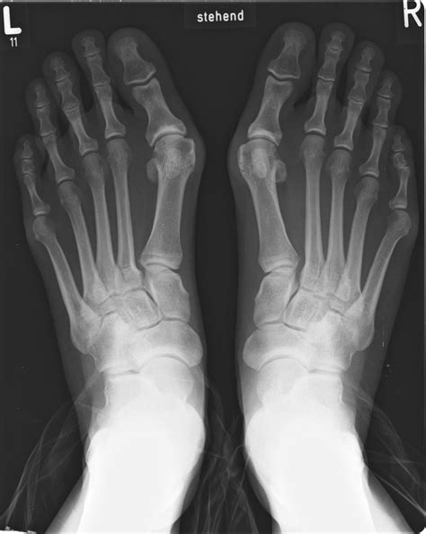 Bunionectomy X Ray