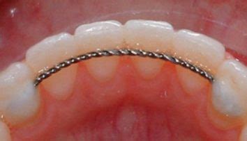 Image result for Retainer Problems