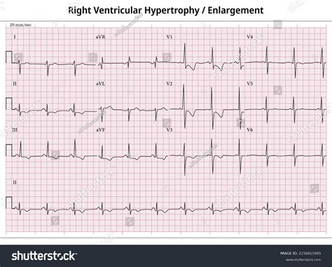 Right Ventricular Hypertrophy (RVH): ECG Criteria Clinical , 44% OFF