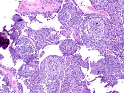 Adenomatoid Odontogenic Tumor