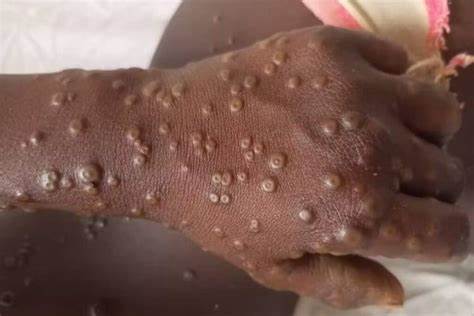 ALERTA da OMS: surto de Mpox na África pode se tornar emergência global ...