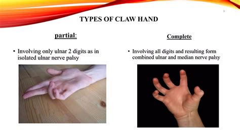 Claw Hand,Definition,Causes,Types,Symptoms and Management | PPTX