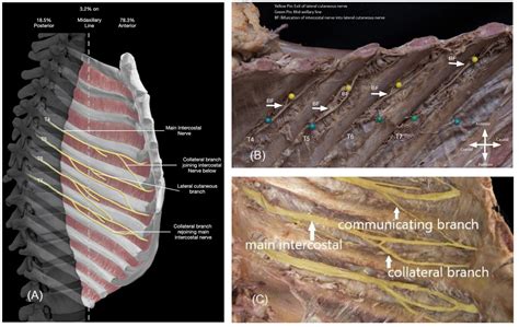 Forgotten Branch of the Intercostal Nerve: Implication for Cryoablation Nerve Block for Pectus ...