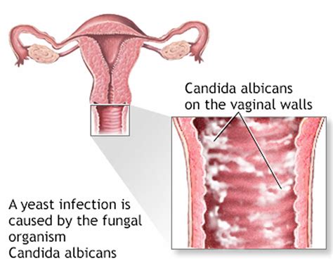 Vaginal yeast infection, causes, symptoms, diagnosis, treatment & prognosis