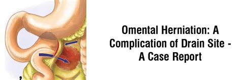 Omental Herniation: A Complication of Drain Site - A Case Report