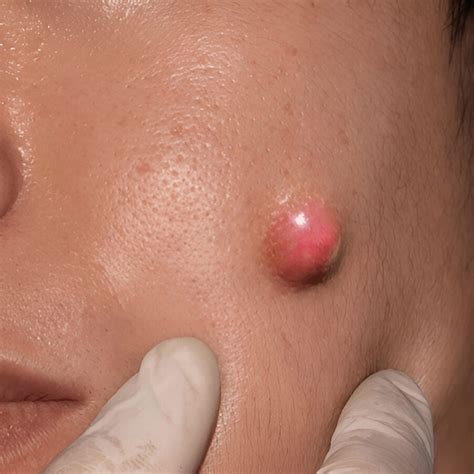 Acne: Causes, Types, and Treatment Plans | Wizderm