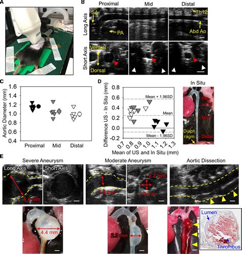 Ultrasound Monitoring of Descending Aortic Aneurysms and Dissections in ...