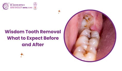 Wisdom Tooth Removal: What to Expect Before and After Dr. Sachin Mittal ...