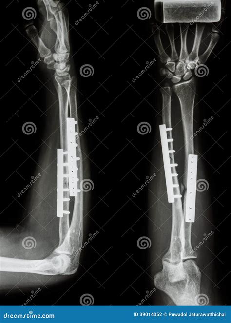 Ulna Bone Fracture