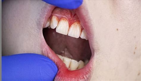 Home Remedy For Bleeding Gums And Pain: how to stop bleeding gums ...