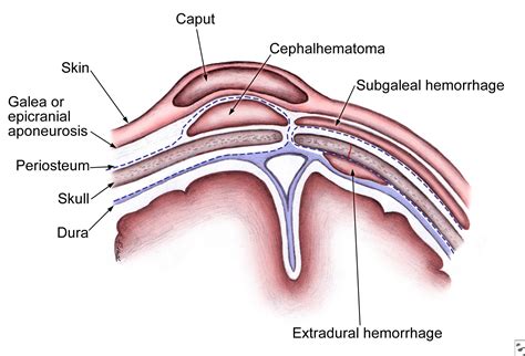 “Difference Between Caput Succedaneum and Cephalhematoma” plus 2 more ...