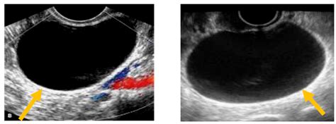 Ovarian Cyst And Cancer Ultrasound Ovarian Cystic Neoplasms