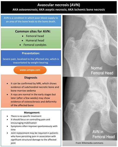 What are the causes of avascular necrosis (AVN) of the femoral head?