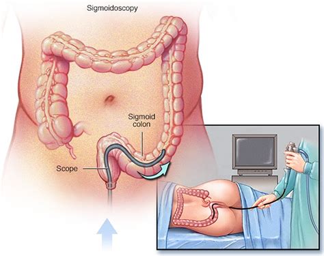 Sigmoidoscopy - Flexible, Rigid Sigmoidoscopy, Prep & Risks