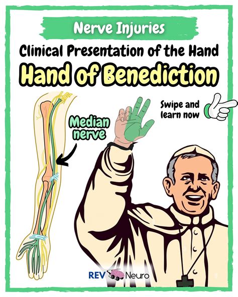 REV MED • Anatomy & Medical Education | Looks like the Pope’s hand of ...