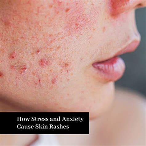 Stress and Skin Rashes Are They Related? | Clinikally