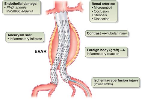 Evar Medical Abbreviation