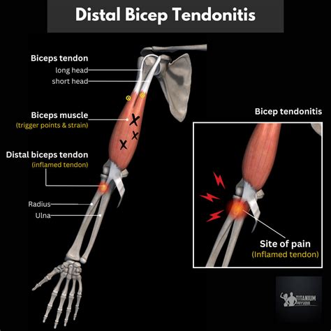 Bicipital Tendonitis Test What Is Distal Biceps Tendonitis & How Does