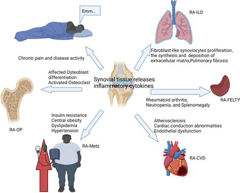 Rheumatoid Arthritis Manifestations Rheumatoid Arthritis' Symptoms