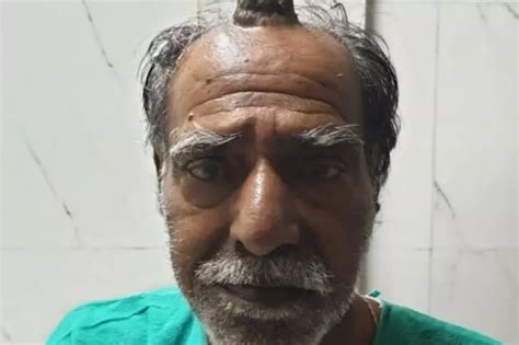 74-YO Madhya Pradesh Man Grows A 'Devil's Horn' On His Head, After Injury