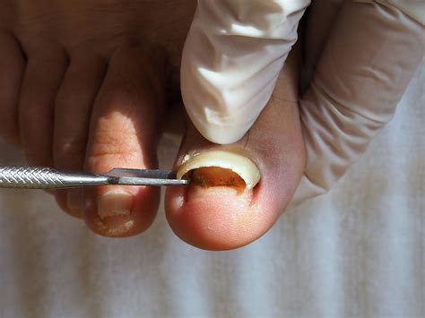 Full Toenail Extraction 的图像结果