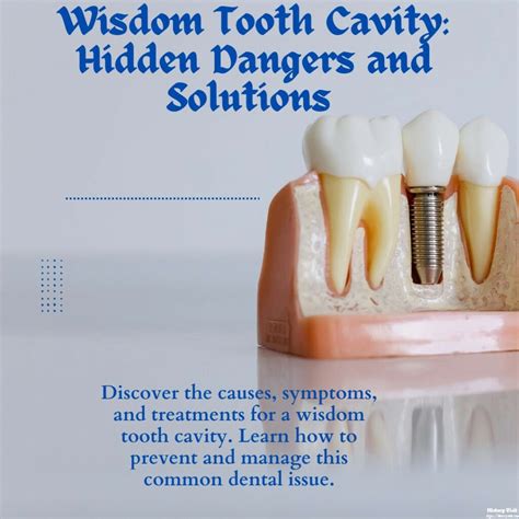 Wisdom Tooth Cavity: Hidden Dangers and Solutions - History Visit