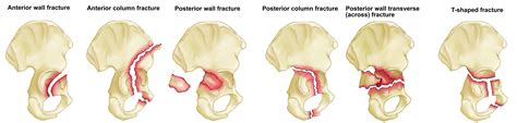 Acetabular fracture causes, symptoms, diagnosis, treatment & prognosis