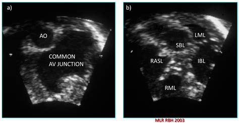 Atrioventricular Septal Defect: What Is in a Name?
