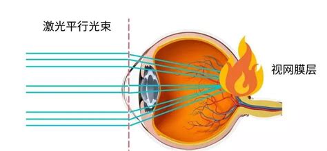 永城同辉眼科科普激光笔照射眼睛，可能会导致孩子眼底永久性损伤！ - 知乎