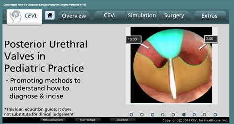 Posterior urethral valves (PUV) in pediatric practice - Promoting ...