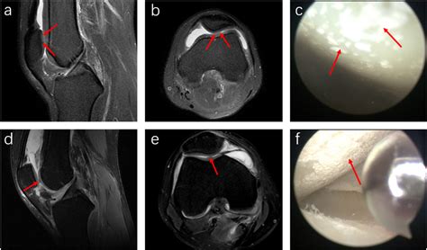 Correlations of characteristics with tissue involvement in knee gouty arthritis: Magnetic ...