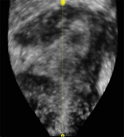Cornual ectopic pregnancy: laparoscopic management step by step | BMJ Case Reports