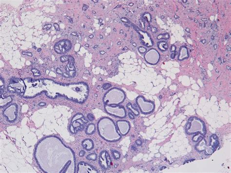 Columnar Cell Change, Flat Epithelial Atypia, and Atypical Ductal Epithelial Hyperplasia ...