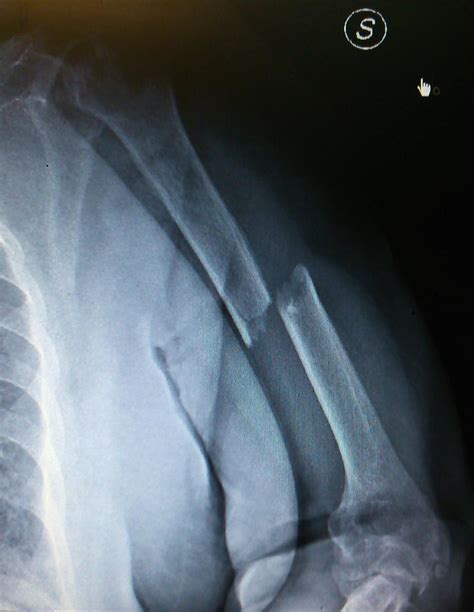 Humeral Shaft Fractures - Trauma - Orthobullets