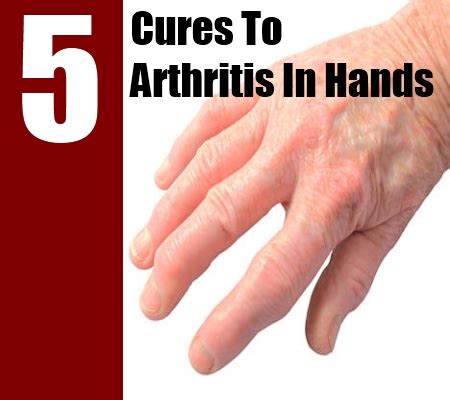 5 Natural Cures For Arthritis In Hands - How To Cure Arthritis In Hands ...