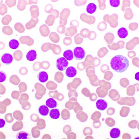 4-Jahres-Update der ELEVATE-TN-Studie mit Acalabrutinib plus Obinutuzu ...