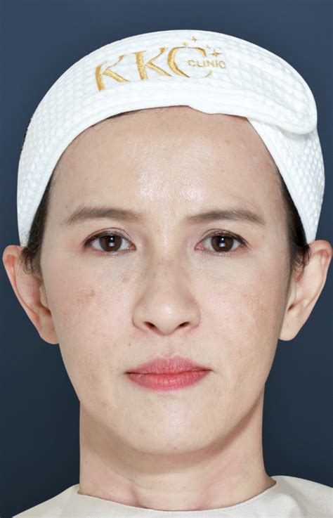 Image result for Thread Lift