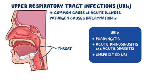 Dry Mouth Upper Respiratory Infection at Natalie Hawes blog