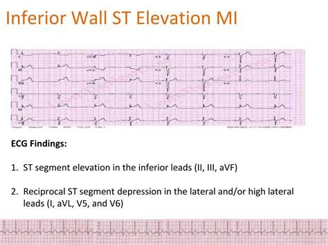 ECG Changes in Myocardial ischemia, myocardial infarction.pptx