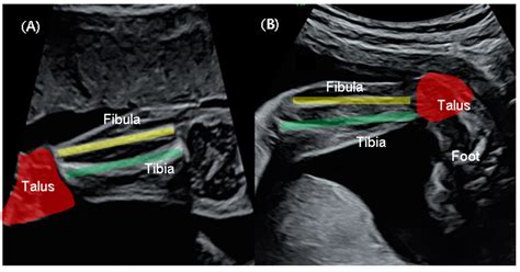 Improving Prenatal Diagnosis Precision for Congenital Clubfoot by Using Three-Dimensional ...