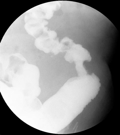 Apple Core Colon Cancer at Joseph Eason blog