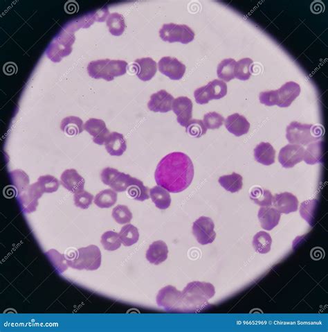 Blast cell on blood smear. stock image. Image of medical - 96652969