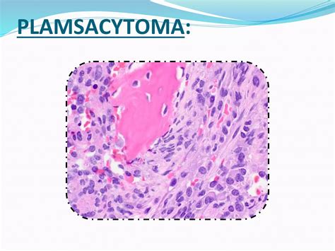 Plasma Cell Dyscrasias.pptx