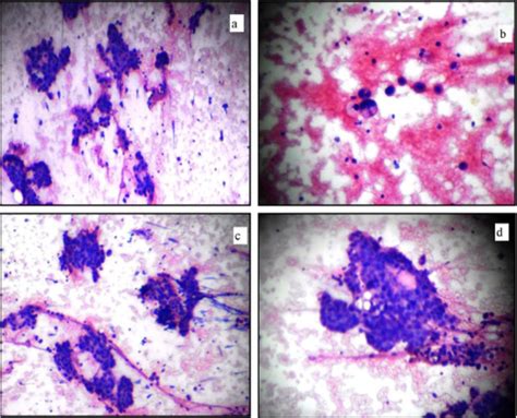 Carcinoma Gall Bladder Presenting as Bilateral Inguinal Lymphnode ...