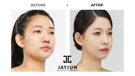 Face Lift Surgery In Korea