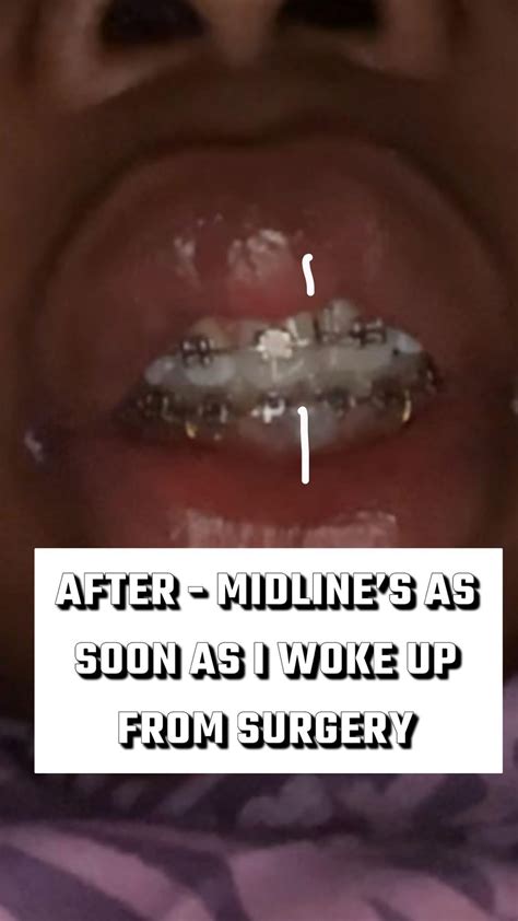 Jaw surgery ruined my face (before/after) : r/jawsurgery