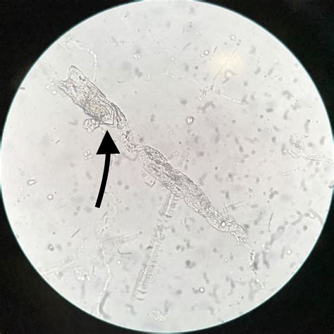 Cholesterol Crystals In Urine Sediment