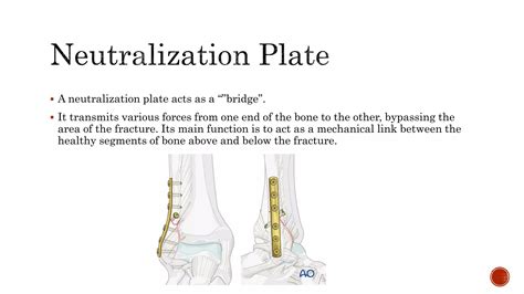 Orthopaedic Plates - types and applications | PPTX